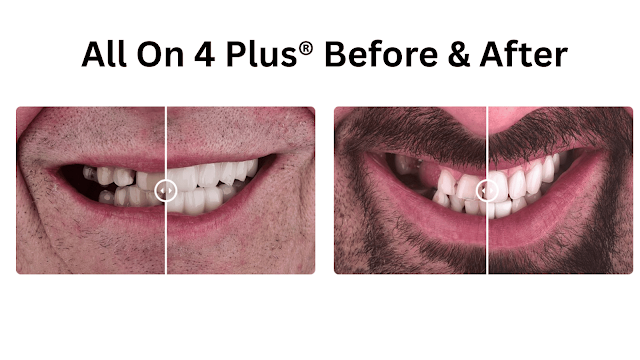 all-on-4-implants-before-and-after-pictures-barbies-beauty-bits