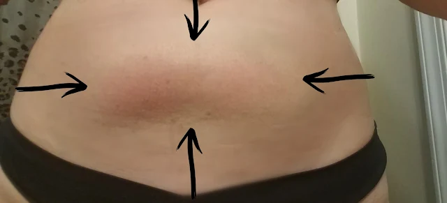 Paradoxical adipose hyperplasia casued from Coolsculpting by barbies Beauty Bits