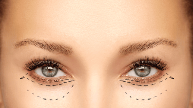 lower-blepharoplasty-surgery-barbies-beauty-bits