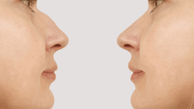 rhinoplasty-recovery-barbies-beauty-bits