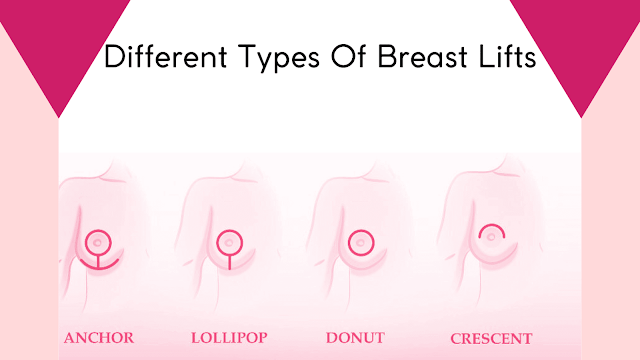 the-different-types-of-breast-lifts-barbies-beauty-bits
